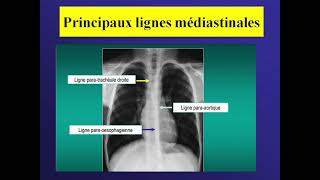 Lecture d’une radiographie thoracique Pathologique Sd Parenchymateux et médiastinal 22 [upl. by Kitchen]