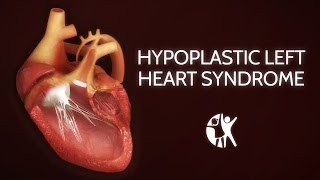 Hypoplastic Left Heart Syndrome HLHS [upl. by Butterfield763]