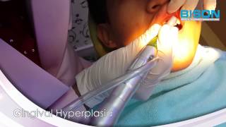 CYMA Dental Video 10600nm CO2 surgical laser  Gingival Hyperplasia [upl. by Kraska]