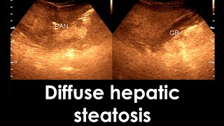 Fatty Liver  Diffuse hepatic steatosis  Liver Ultrasonogram [upl. by Ardnad235]