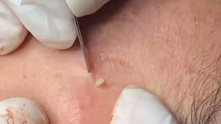 how to remove blackheads from nose with tool removeblackhead [upl. by Acirderf533]