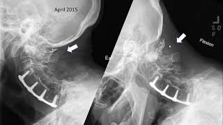 Spine Conference Occipital Cervical Instability [upl. by Onileba]