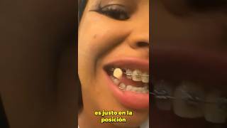 ¿Puedo usar dientes provisionales con brackets Aquí tiene la respuesta [upl. by Kassity298]