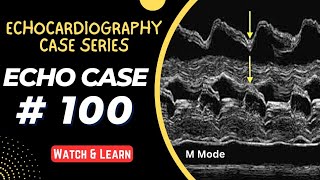 ECHO CASE 100  Echocardiography for Beginners  M Mode Echocardiogram [upl. by Ulyram]