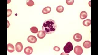 Megaloblastic Anemia  Macrocytic Anemia overview [upl. by Upshaw]