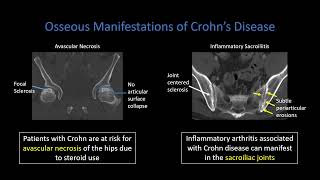 Crohn Disease Part 3 Extraintestinal Findings [upl. by Rennat]