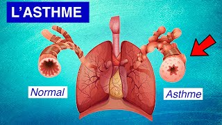 Asthme bronchique  Physiopathologie Symptômes et Traitements [upl. by Yrogreg433]