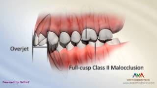 Malocclusion  Class II Div I [upl. by Castera]