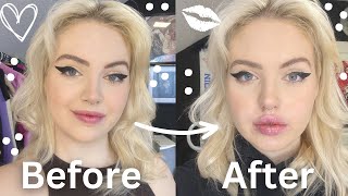 GETTING LIP FILLER FOR THE FIRST TIME VLOG 👄🩷 [upl. by Bloomer125]