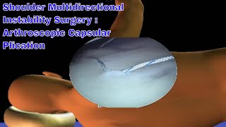 Arthroscopic Multidirectional Instability Shoulder Surgery  Dont Let Your Shoulder Pain Win [upl. by Adnawahs580]