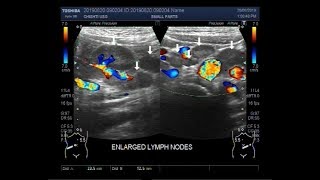 Ultrasound Video showing Mesenteric lymphadenitis with an inflamed gut loop [upl. by Ciredor262]