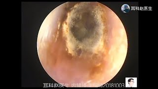 Treatment of fungal otitis externa by ear endoscope for 12 minutes 耳内镜处理真菌性外耳道炎，12分钟 [upl. by Annahoj]