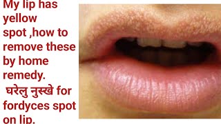 My lip has yellow and white spot what to do for cureFordyces spot on lips and its homes remedy [upl. by Ettena]