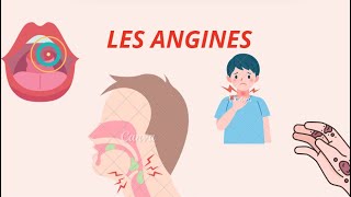 Angines  Types Symptômes et Traitements – Tout ce quil Faut Savoir [upl. by Pius]