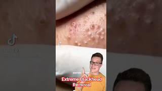 EXTREME BLACKHEAD REMOVAL  Blackhead Popping At Its Best shorts [upl. by Sanyu]