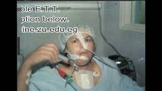 Awake extubation tolerable endotracheal tube myasthenia [upl. by Zoldi]