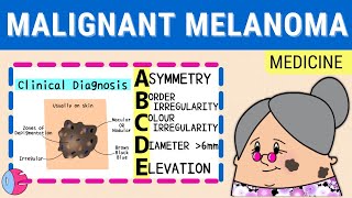 Malignant Melanoma All You Need To Know [upl. by Win333]