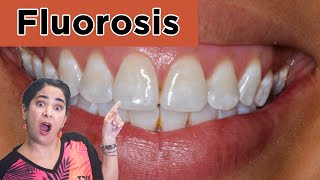 🚨 Fluorosis dental [upl. by Pammie]