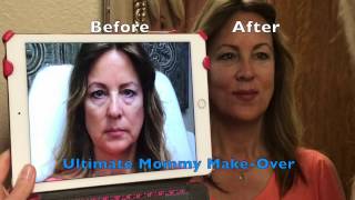 LIQUID FACELIFT  ULTIMATE Dermal Filler MAKEOVER [upl. by Meid668]