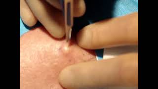 Skin surgery  epidermoid sebaceous cyst removal 1 [upl. by Melan]