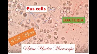 Pus cells in urine  Pyurea cause symptoms and investigation under microscope [upl. by Nunnery]