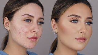 HOW TO COVER ACNE SCARS easy amp non cakey [upl. by Ellehcem]