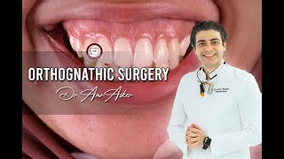 Orthognathic Surgery [upl. by Tutt]