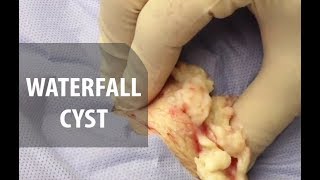 Waterfall Cyst  Dr Derm [upl. by Bert]