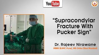 Supracondylar Fracture with Pucker Sign by Dr Rajeev Nirawane [upl. by Giles]