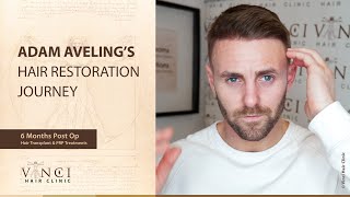 Adam Aveling’s hair restoration journey with Vinci Hair Clinic [upl. by Elyse396]