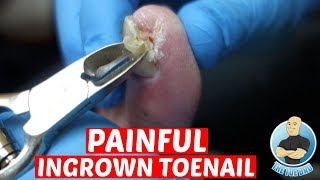 EXTREME PAINFUL INGROWN TOENAIL REMOVALDID IT HURT TO REMOVE IT [upl. by Nitin]