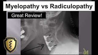 Myelopathy vs Radiculopathy  Great Review [upl. by Sender]