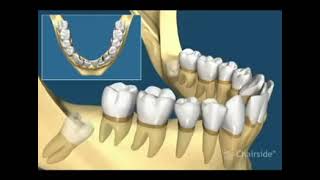 Pourquoi et quand extraire les dents de sagesse [upl. by Artemisia]