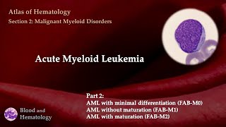 Acute Myeloid Leukemia AML  Part 2 [upl. by Bohman]