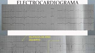 CARDIOPATIA HIPERTENSIVA Y DISFUNCION VENTRICULARwmv [upl. by Ycniuqal]