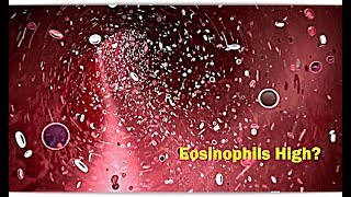 Eosinophils High Low – Causes [upl. by Atinaujnas]