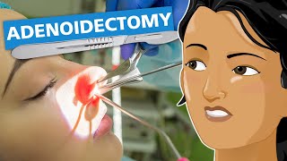 Adenoidectomy [upl. by Aneleairam470]