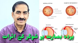 Eye  Diabetic Retinal Effects  پردہ بصارت پر شوگر کے اثرات [upl. by Arval]