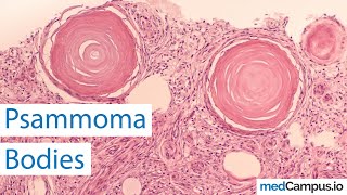 Psammoma bodies  Pathological bodies [upl. by Idelson]