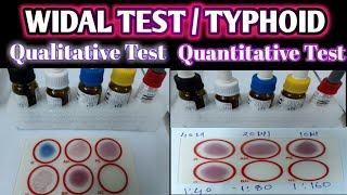 Widal Test Practical  Qualitative Widal Test  Quantitative Widal Test  Typhoid Test [upl. by Carrington]