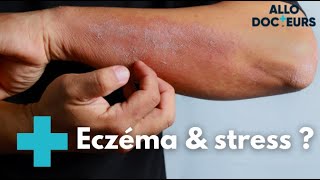 Eczéma  quelles solutions   Allo Docteurs [upl. by Avitzur]