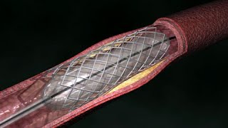 Angioplastia de arteria coronaria Vía radial [upl. by Amaso727]