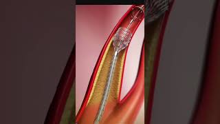 ANGIOPLASTY PROCEDURE ANIMATED [upl. by Eile]