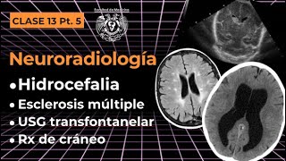 135  Neuroradiología Hidrocefalia EM USG Transfontanelar y Rx Cráneo [upl. by Nibroc229]