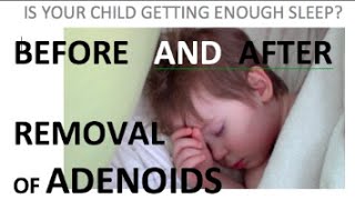 Before and After removal of adenoids 3 year old with sleep apnea and nasal speech [upl. by Cogn]