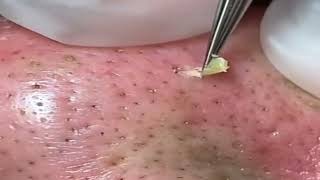 shorts Huge Blackheads Removal with a Tweezer 01 [upl. by Allissa]