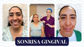 SONRISA GINGIVAL BÓTOX para dejar de mostrar las ENCÍAS al SONREÍR I MARISOL GÓNGORA [upl. by Lauralee318]