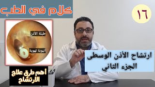 ارتشاح الأذن الوسطى الجزء الثاني otitis media with effusion part two [upl. by Vez58]