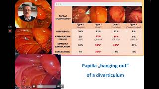 ERCP  Precut Sphincterotomy Using the Huibregtse Needle KnifeBiliary Catheter [upl. by Matty]