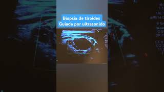 BIOPSIA DE TIROIDES GUIADA PPR ULTRASONIDO [upl. by Curt]